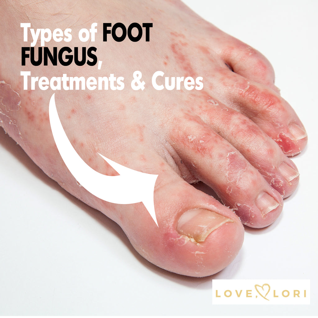 Types of Foot Fungus — Athlete's Foot Symptoms and Treatment