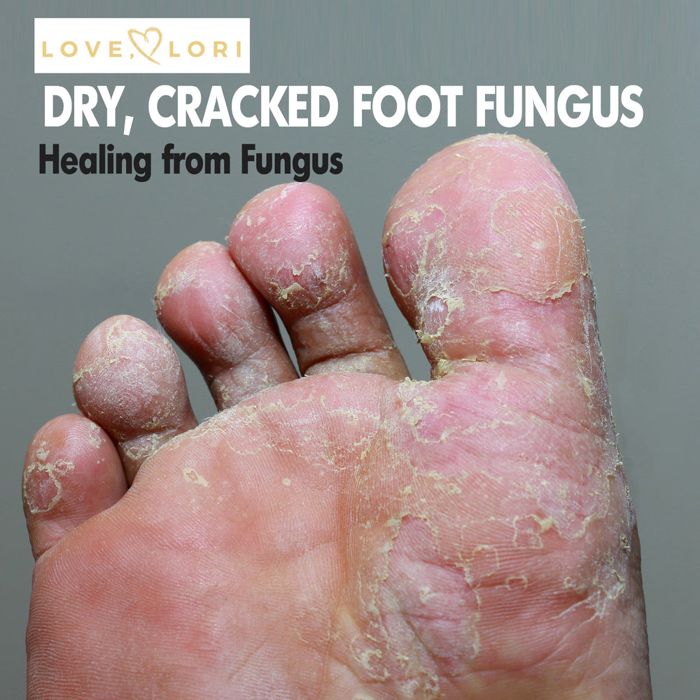 Homeopathic Nail Fungus Treatment Extra Strength | Forces of Nature Medicine
