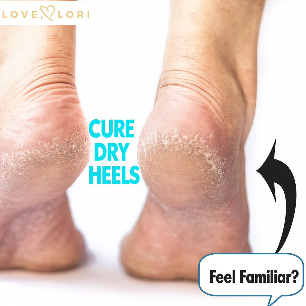 Cracked Heels: Causes, Symptoms, Treatment and Prevention