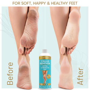 Foot Cure Extra Strength Foot Callus Remover Gel & Foot at-Home